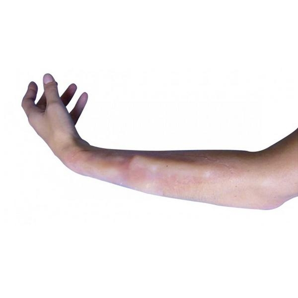 Prothèse de fracture fermée avant-bras tibia et clavicule