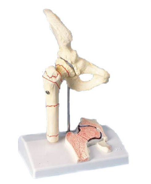 fracture du fémur et usure de l'articulation de la hanche