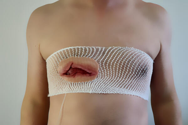 Plaie Filet Soufflante du Thorax