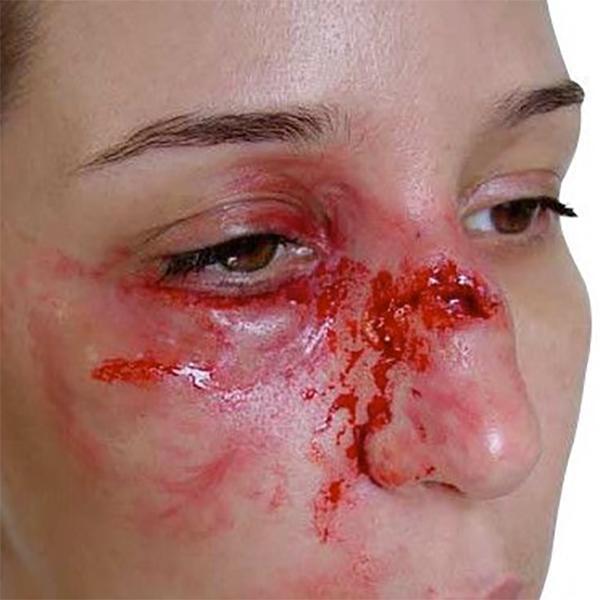 Prothèse Fracture du Nez avec Pommette Gonflée