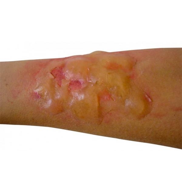 Prothèse de Brûlure Grave