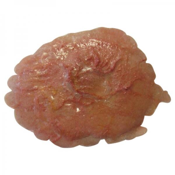 Plaie Filet Brûlure Thermique Simple