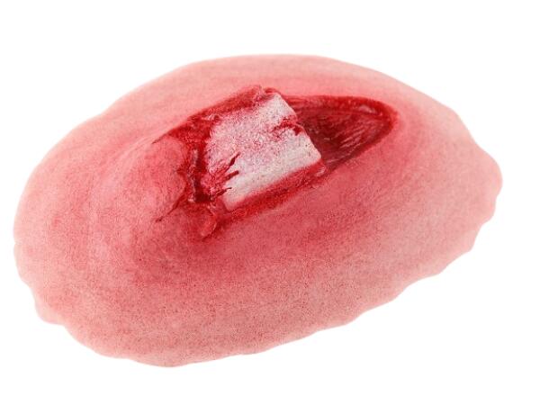 Plaie Filet Fracture Ouverte du Tibia