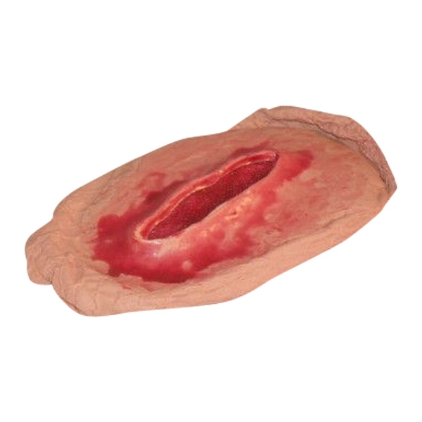 Plaie Filet Hémorragique Fémorale