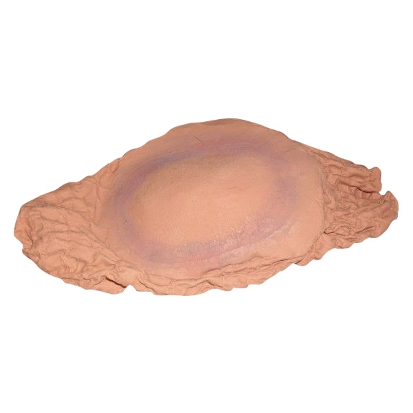 Plaie Filet Fracture Fermée