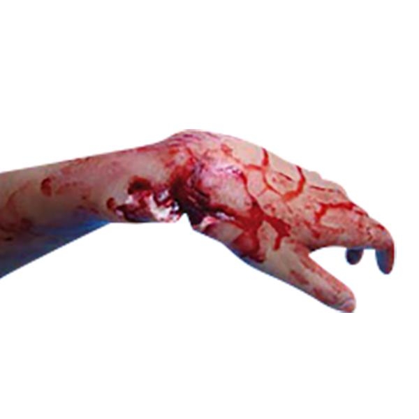 Prothèse de Fracture Ouverte du Poignet Pas Cher