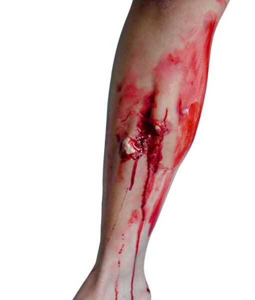 Prothèse de Fracture Ouverte du Tibia