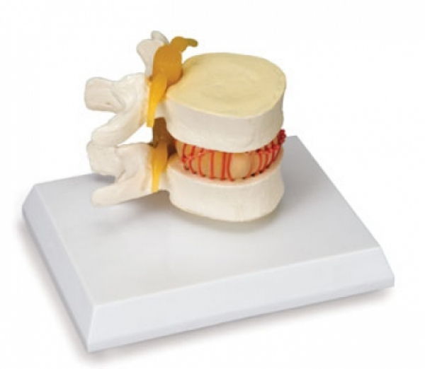 Simulateur D’hernie Discale