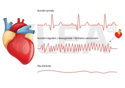 rythme_fibrillation_ylea_400